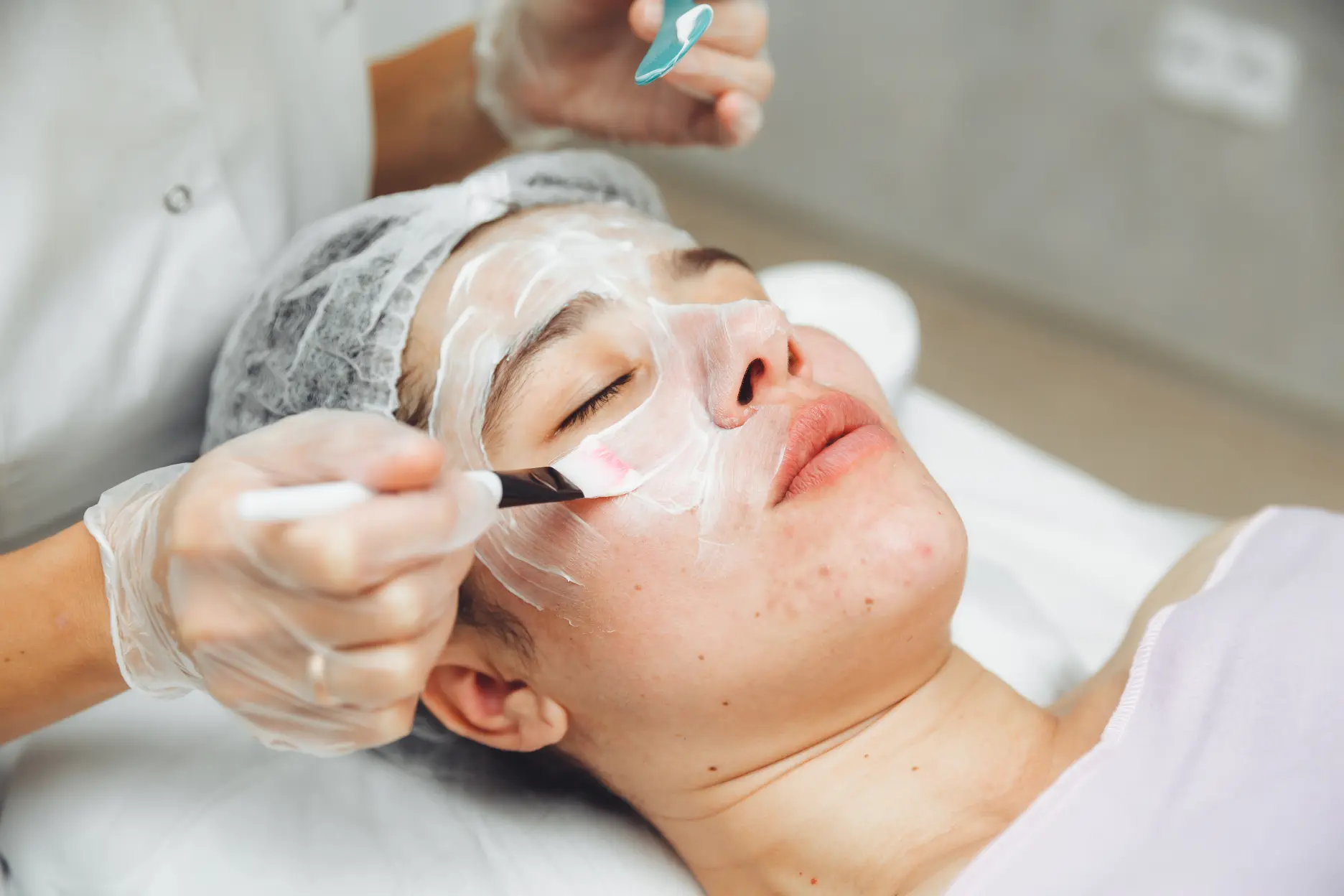 Acne Treatment